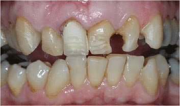 Old restaurations discoloration and crowding