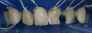 Old restaurations discoloration and crowding