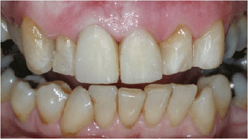 Old restaurations discoloration and crowding