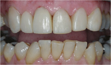 Old restaurations discoloration and crowding