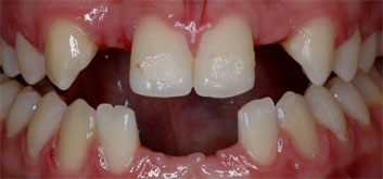 Multiple agenesia, diastema