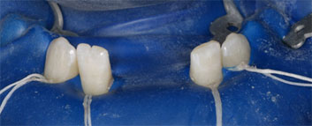 Multiple agenesia, diastema
