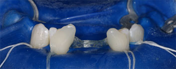 Multiple agenesia, diastema
