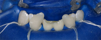 Multiple agenesia, diastema