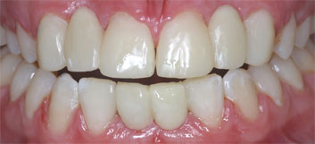 Multiple agenesia, diastema