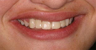 Multiple agenesia, diastema