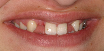 Multiple agenesia, diastema