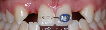 Multiple agenesia, diastema