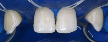 Multiple agenesia, diastema
