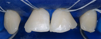 Multiple agenesia, diastema