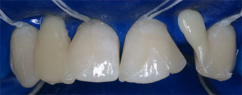 Multiple agenesia, diastema