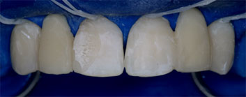 Multiple agenesia, diastema