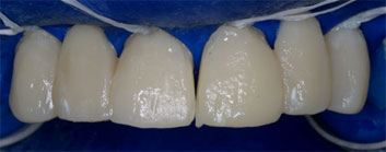 Multiple agenesia, diastema