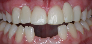 Multiple agenesia, diastema