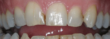 Cross-bite