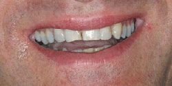 Cross-bite