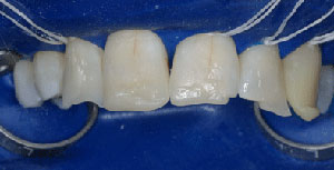Cross-bite