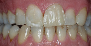 Cross-bite