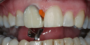 Cross-bite