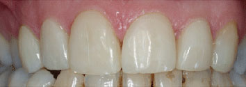 Cross-bite