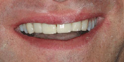 Cross-bite