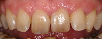 Class II/2, Incisal wear, discoloration