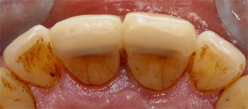 Class II/2, Incisal wear, discoloration