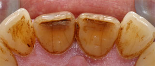 Class II/2, Incisal wear, discoloration