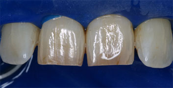 Class II/2, Incisal wear, discoloration