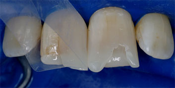 Class II/2, Incisal wear, discoloration