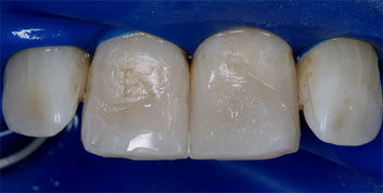 Class II/2, Incisal wear, discoloration