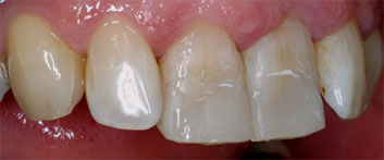 Class II/2, Incisal wear, discoloration