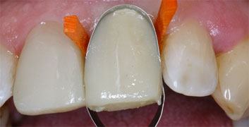 Class II/2, Incisal wear, discoloration