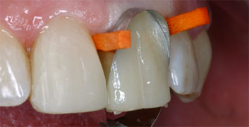 Class II/2, Incisal wear, discoloration