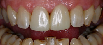 Class II/2, Incisal wear, discoloration
