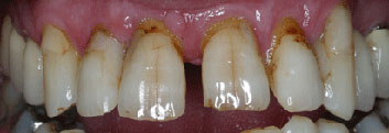Diastema closing