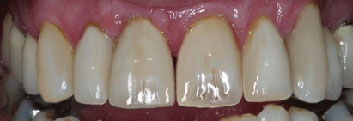 Diastema closing