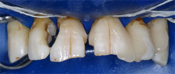 Diastema closing