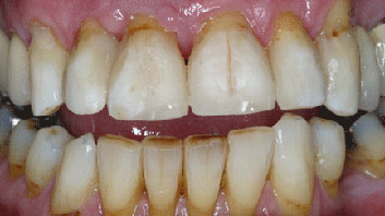 Diastema closing
