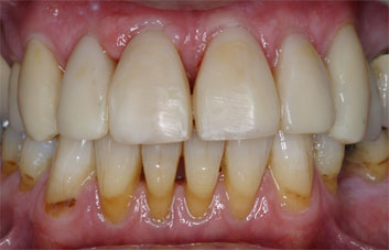 Diastema closing