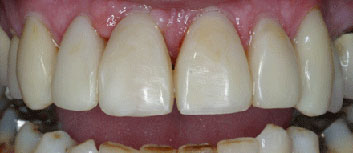 Diastema closing