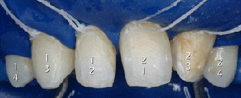 Schisis and missing elements