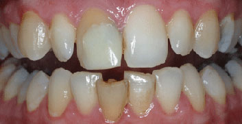 Endodontic discolorations