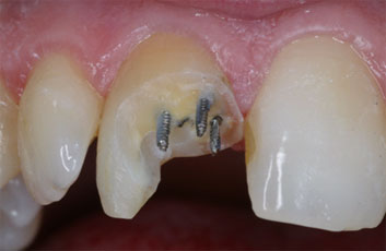 Endodontic discolorations