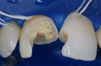 Endodontic discolorations