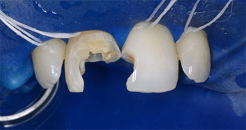 Endodontic discolorations