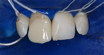Endodontic discolorations