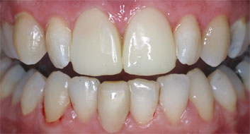 Endodontic discolorations