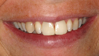 Endodontic discolorations