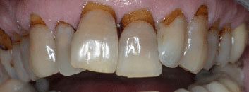 Tetracycline discoloration